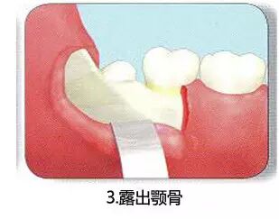 拔牙流程图，你们不懂这种痛！971 / 作者:火星娃崽 / 帖子ID:113290