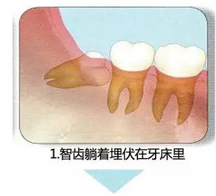 拔牙流程图，你们不懂这种痛！941 / 作者:火星娃崽 / 帖子ID:113290