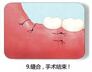 拔牙流程图，你们不懂这种痛！74 / 作者:火星娃崽 / 帖子ID:113290