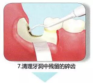 拔牙流程图，你们不懂这种痛！639 / 作者:火星娃崽 / 帖子ID:113290