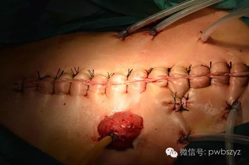 肠瘘肠梗阻典型病例系列之005----结肠癌术后反复肠梗