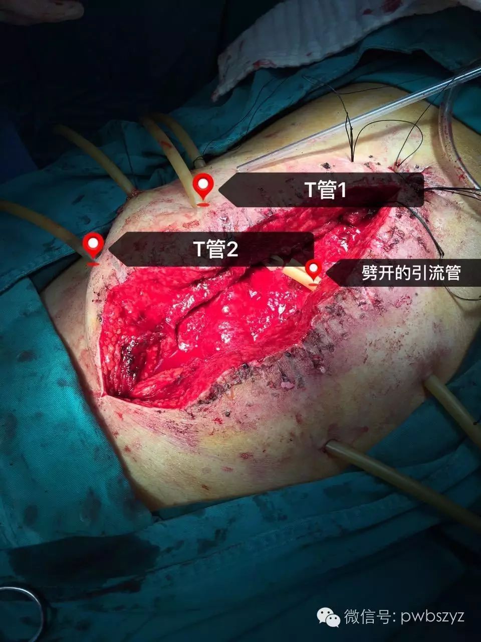 处理方法:在瘘口远近端各置24号t管一根行空肠造瘘,瘘口处行4-0可吸收