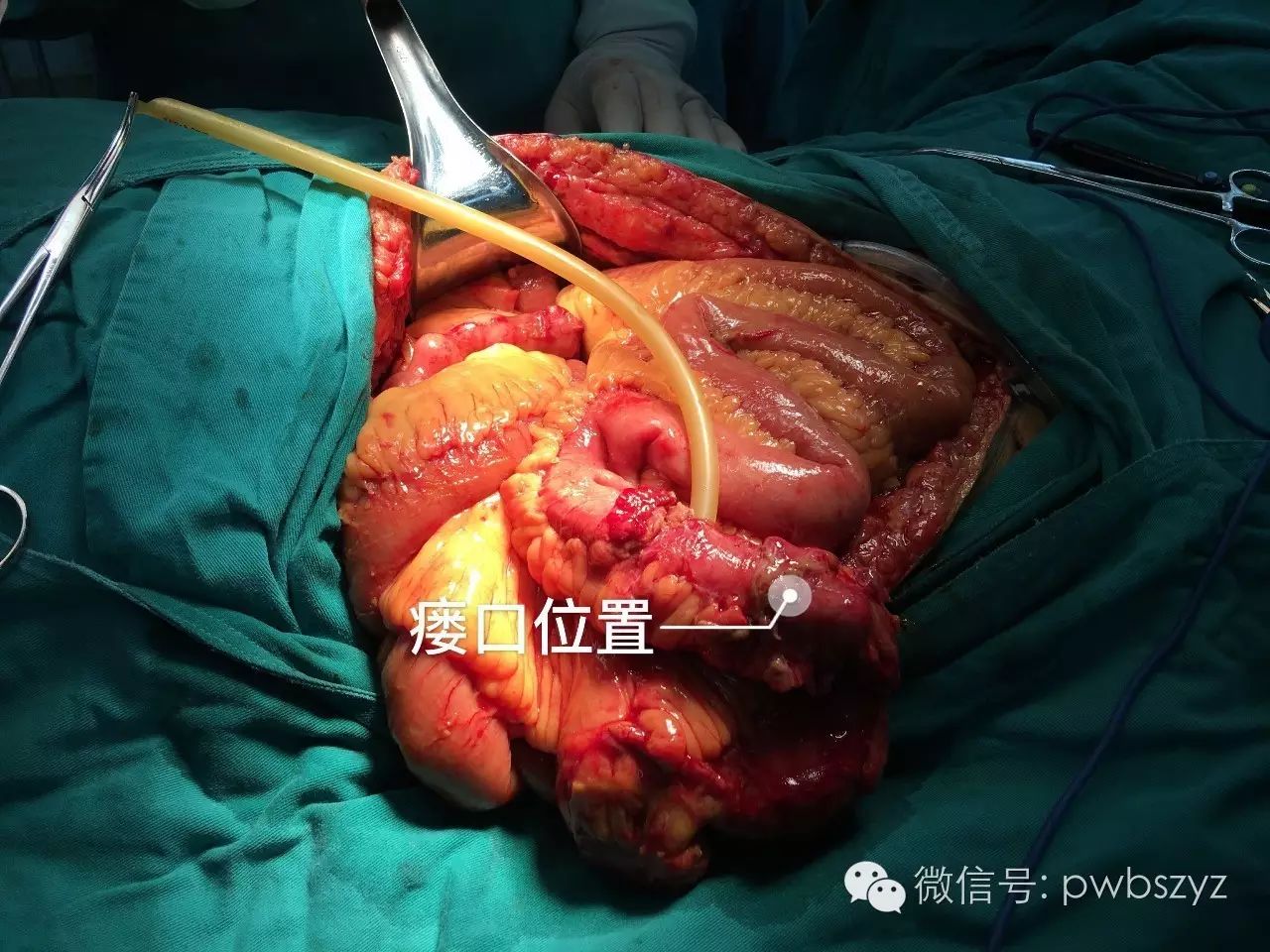 肠瘘肠梗阻典型病例系列之006----肠瘘合并肠梗阻治疗