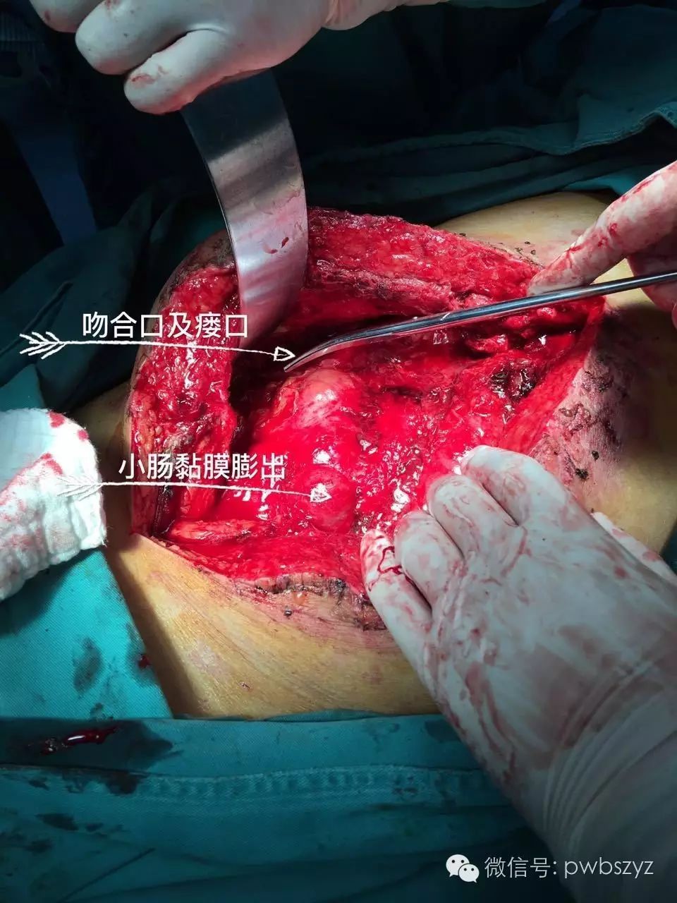 肠瘘肠梗阻典型病例系列之006肠瘘合并肠梗阻治疗