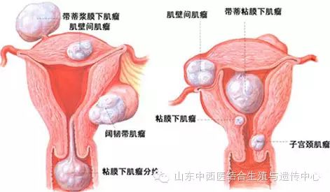 备孕前发现子宫肌瘤怎么办?