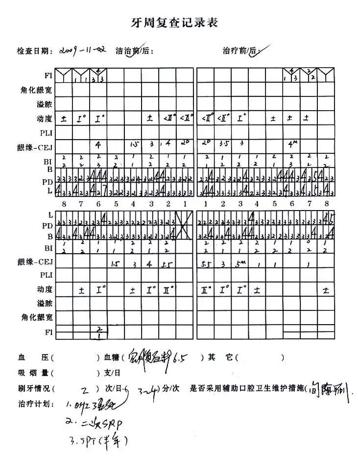 图4 牙周治疗前牙周检查记录表 矫治计划 1.3m矫治器,mbt技术. 2.