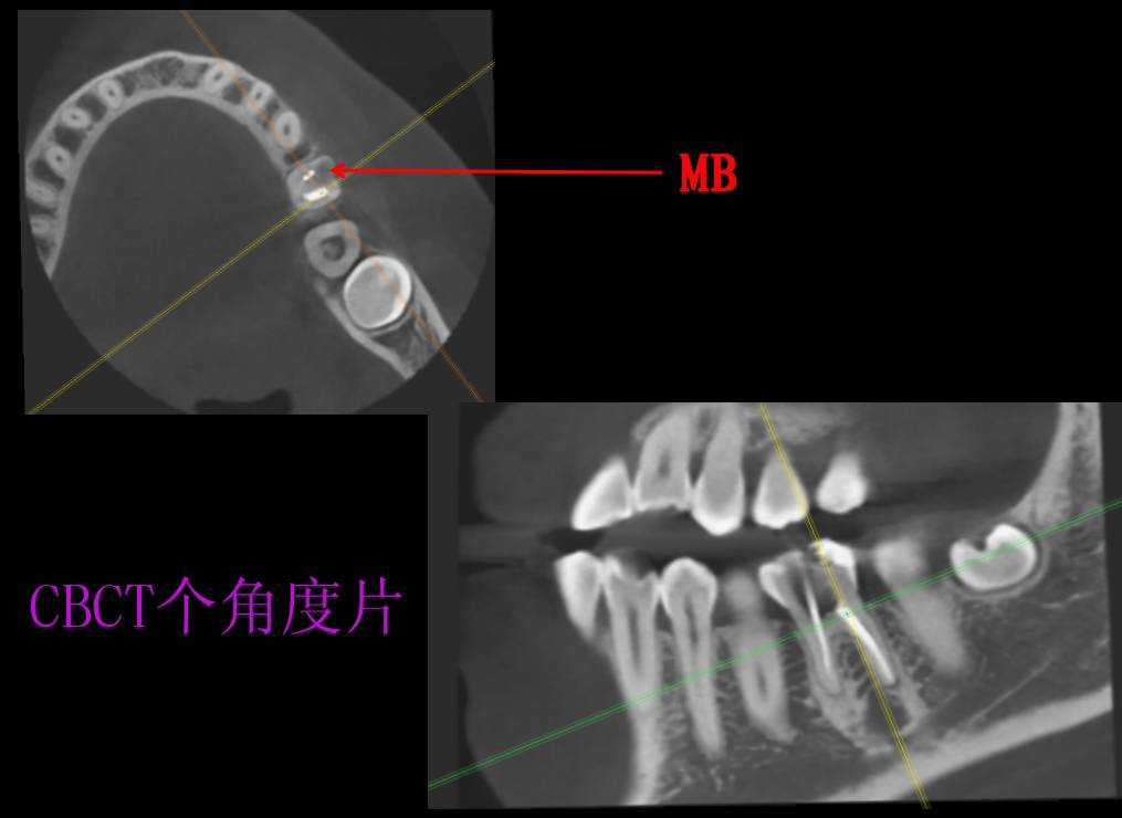 下颌第一磨牙近中3根管的治疗体会和思考