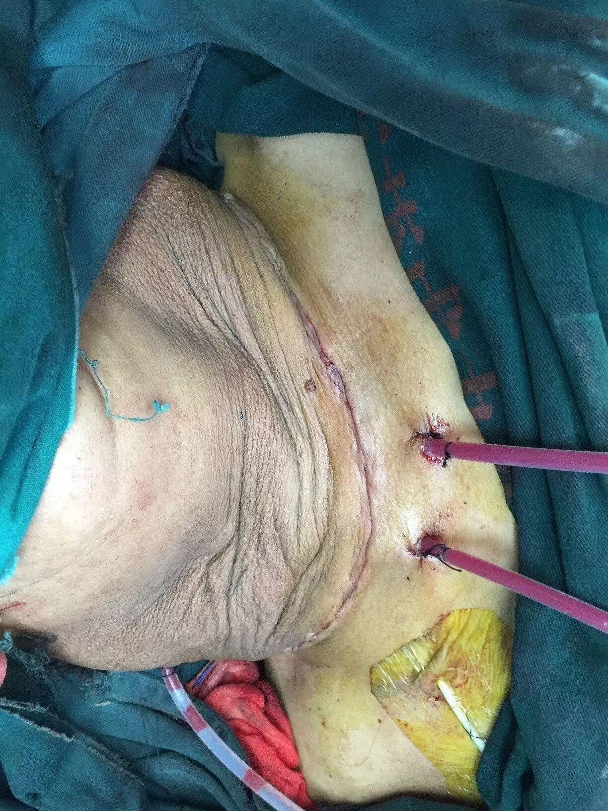 病例讨论：巨大甲状腺肿瘤切除术的麻醉处理