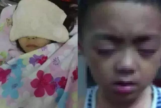 学校误开紫外灯致20个孩子眼灼伤，安全用灯需注意哪些？