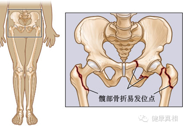 [020]青春期喝更多牛奶会降低成年后的髋部骨折吗?