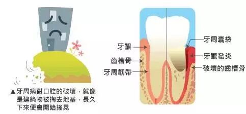 【口腔科普】牙周病治疗的四个阶段