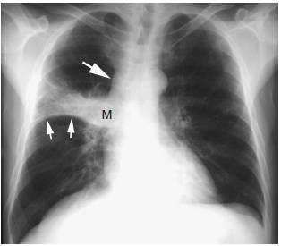 5类肺癌的影像学表现(多图)