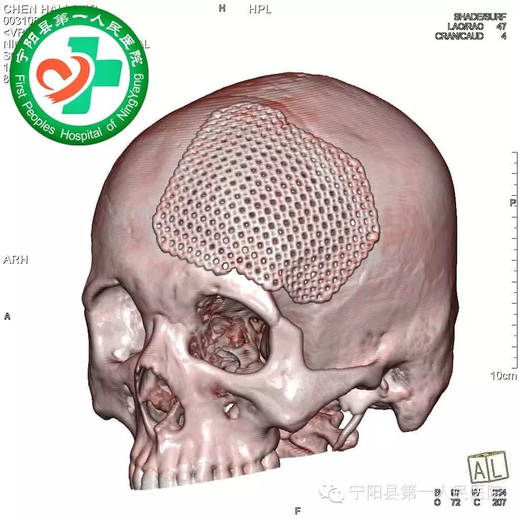 三维钛板颅骨修补临床应用