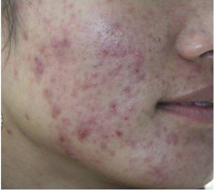 痤疮和毛囊炎傻傻分不清？它们居然这么大危害！