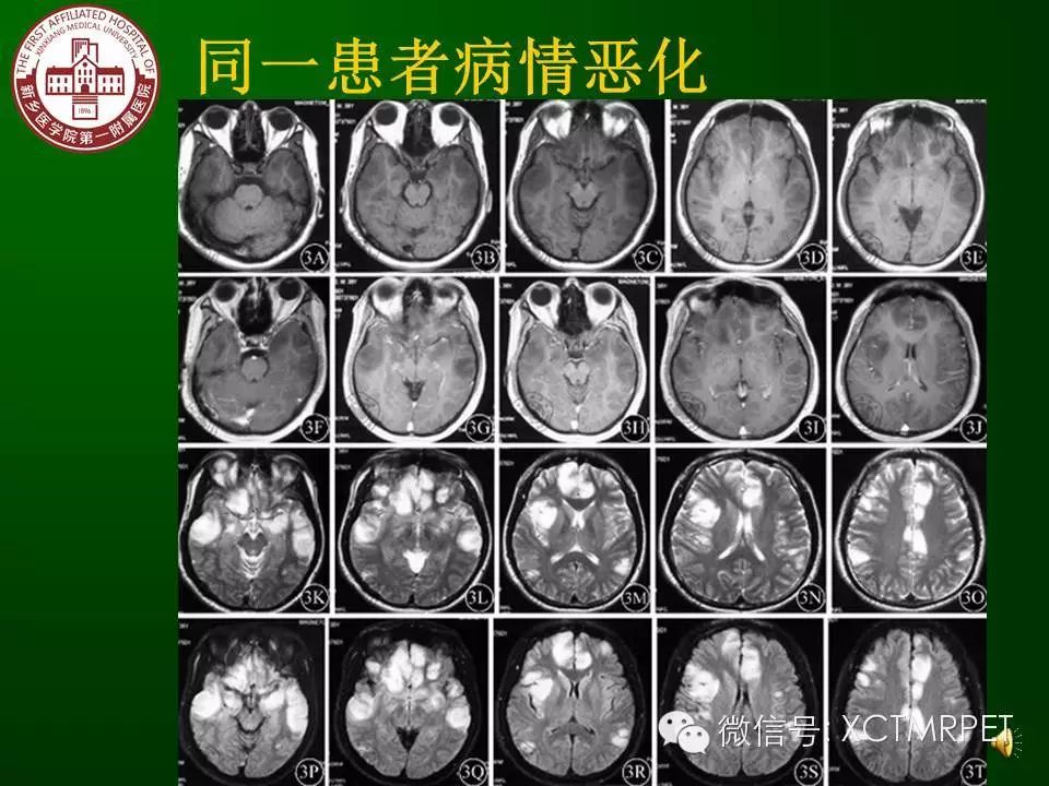 自身免疫性脑炎的mri评价