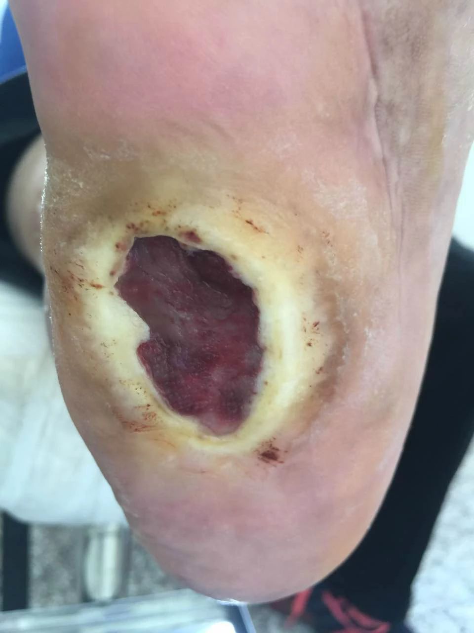 元宵寄语莫让偏见遮望眼宫氏治疗双足腁胝病例宫氏治疗腿抽动与夜尿过
