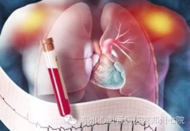 张杰主任为您讲解如何正确了解扩张型心肌病