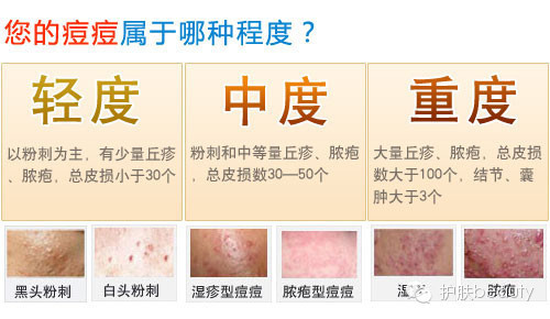 结节型豆豆  硬节型痘痘是炎症的后期表现,炎症带来纤维增生,痘痘