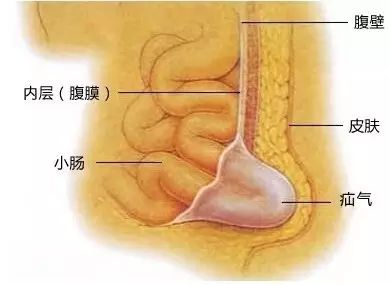 什么叫做疝？