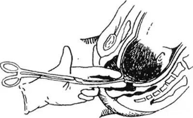 妇科器械怎么使用妇产科常见手术器械大盘点_https://www.jmylbn.com_新闻资讯_第27张