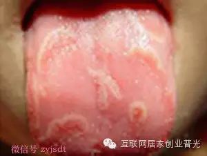 看舌头判断宝宝生了什么病