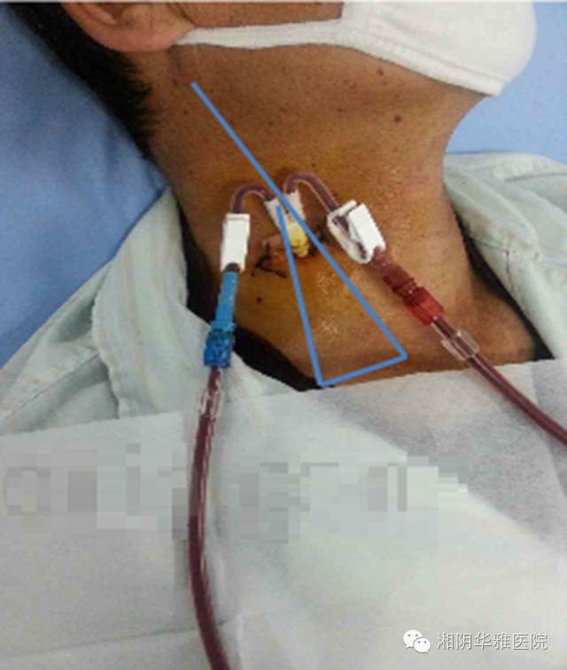 [华雅医讯]中心静脉置管术在血液透析中的应用及注意事项