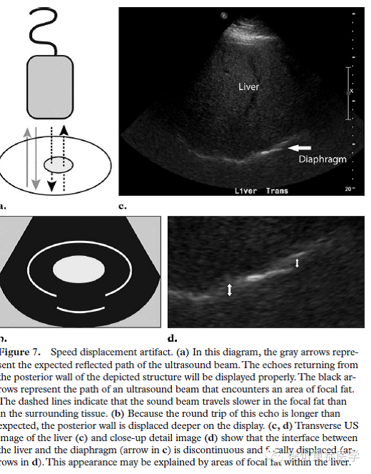 彩超伪像是什么超声伪像 丨US Artifacts_https://www.jmylbn.com_新闻资讯_第9张