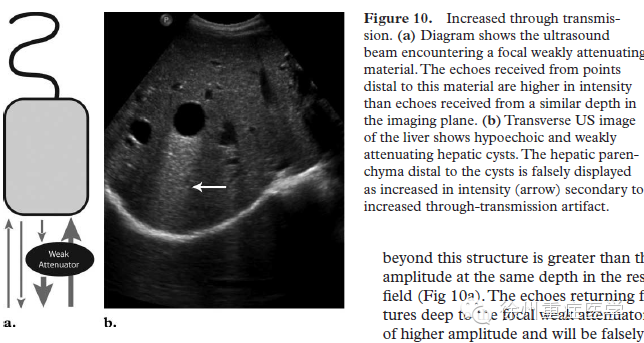 彩超伪像是什么超声伪像 丨US Artifacts_https://www.jmylbn.com_新闻资讯_第13张