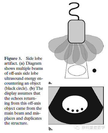 彩超伪像是什么超声伪像 丨US Artifacts_https://www.jmylbn.com_新闻资讯_第4张