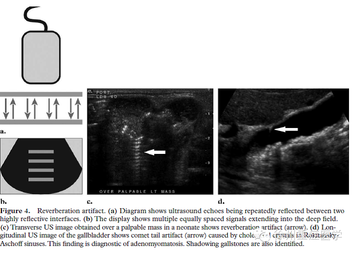 彩超伪像是什么超声伪像 丨US Artifacts_https://www.jmylbn.com_新闻资讯_第6张