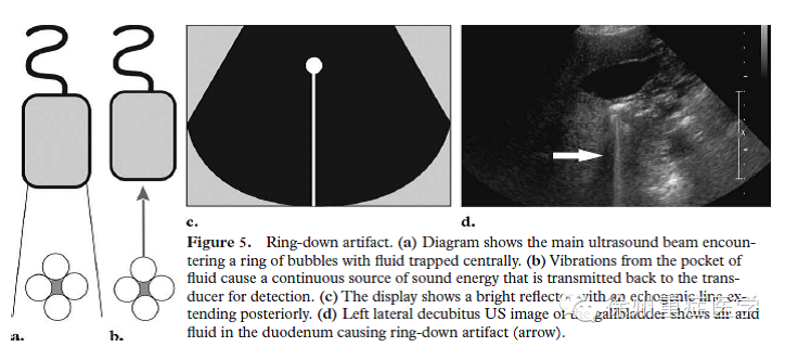 彩超伪像是什么超声伪像 丨US Artifacts_https://www.jmylbn.com_新闻资讯_第7张