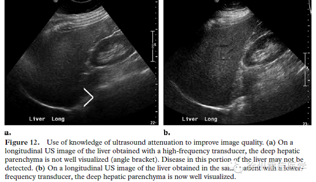彩超伪像是什么超声伪像 丨US Artifacts_https://www.jmylbn.com_新闻资讯_第14张