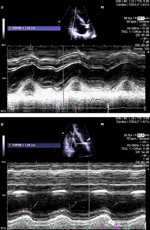 超声心动图和心衰(Ⅱ) 勿忘右心 那惊鸿的一瞥