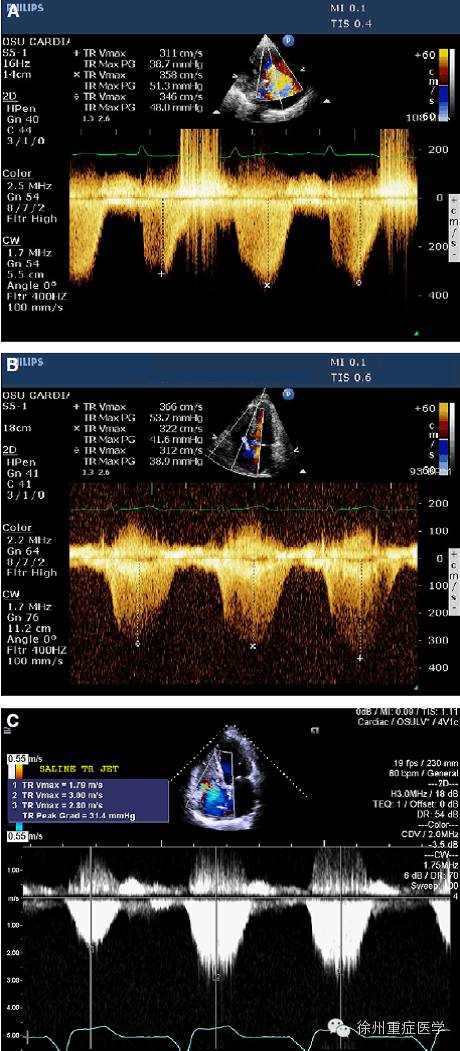 超声心动图和心衰(Ⅱ) 勿忘右心 那惊鸿的一瞥