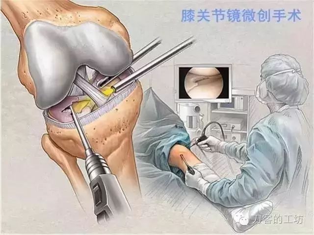 刀客说疼痛---膝关节疼痛之半月板