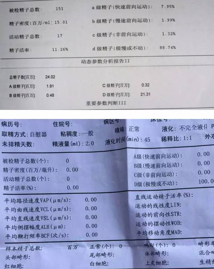 举例说明几张化验单,顺便科普一下男性精液报告: 上图:少弱精症;下