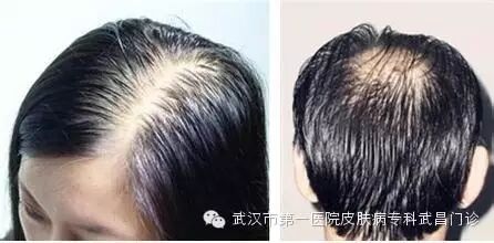 [爱护发]如何防止脂溢性脱发？