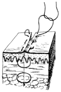 为什么要用皮钉缝合洛阳亲友如相问，就说我在练缝皮 ｜ 一页手册·协和八_https://www.jmylbn.com_新闻资讯_第3张