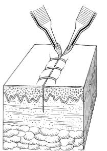 为什么要用皮钉缝合洛阳亲友如相问，就说我在练缝皮 ｜ 一页手册·协和八_https://www.jmylbn.com_新闻资讯_第8张