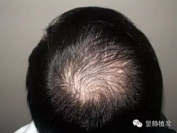 头发出现斑秃怎么办，揭秘斑秃最好的治疗方法
