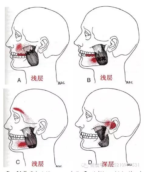 学习激痛点3(咬肌(浅层masseter)与牙痛的关系