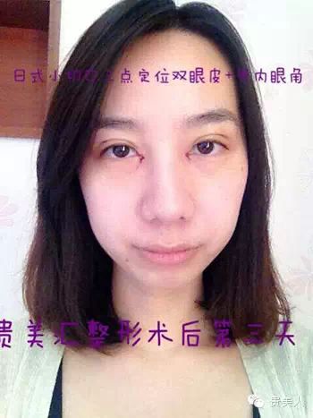 日式小切口三点定位双眼皮 开内眼角