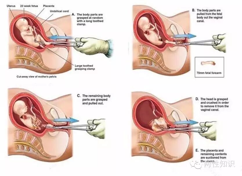 两性知识:人流与药流哪种好呢?-怀孕期