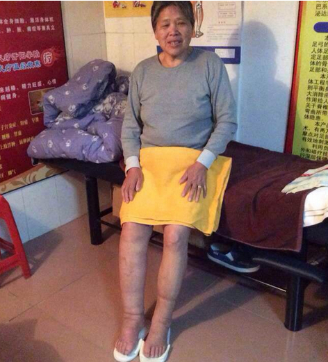大象腿可以用权健火疗调理吗?