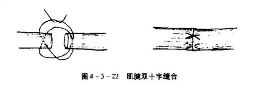 适用于 较粗的肌腱断裂缝合.