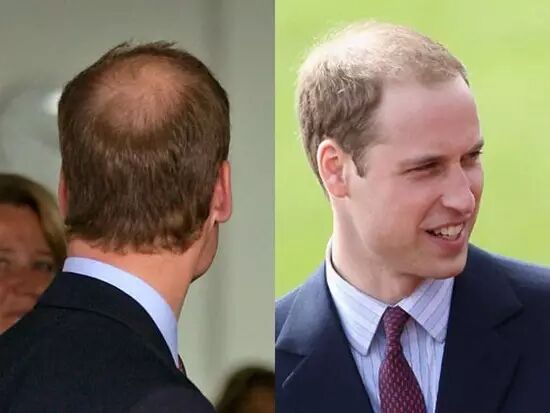 发际线日益升高？该怎么办？你一定要看看这篇文章