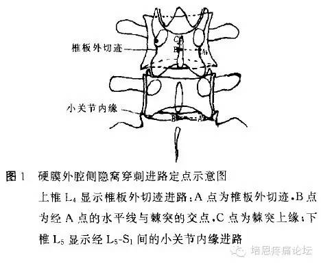 侧隐窝阻滞综述