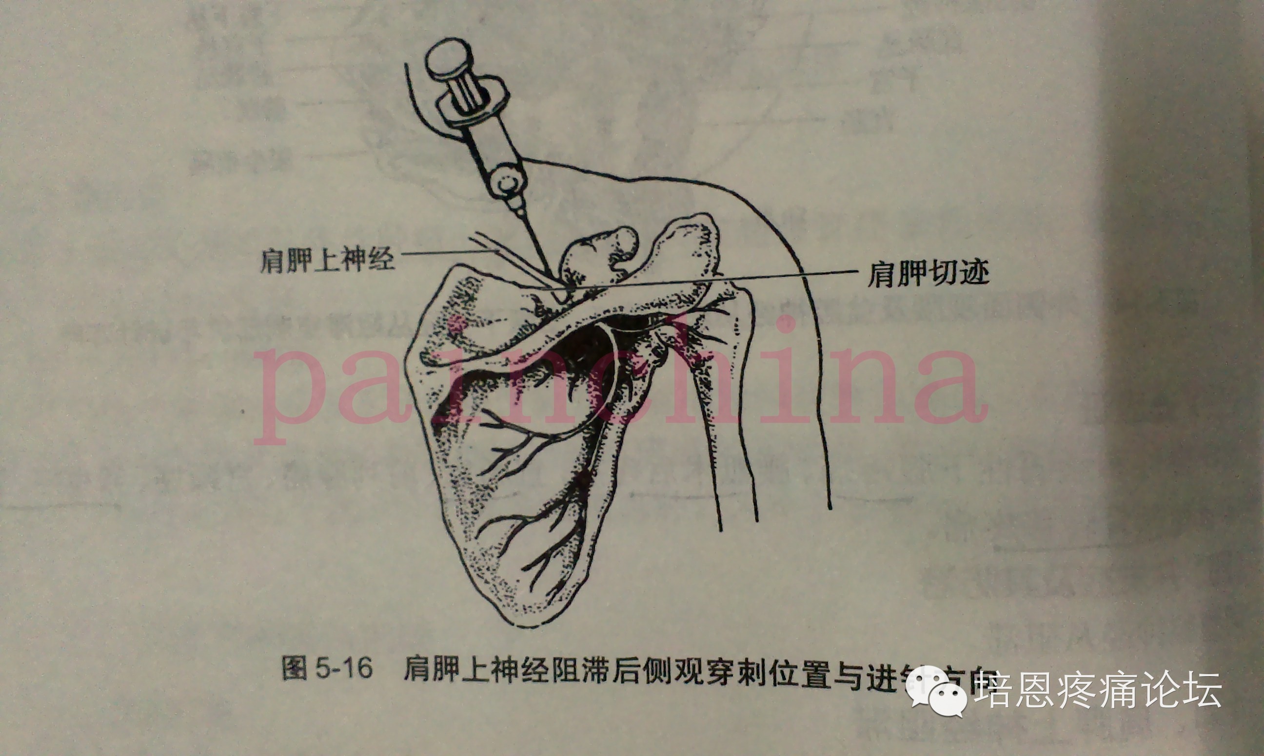 均分为二等分和三等分,其中点与外1/3连线中点前缘,即为肩胛上神经