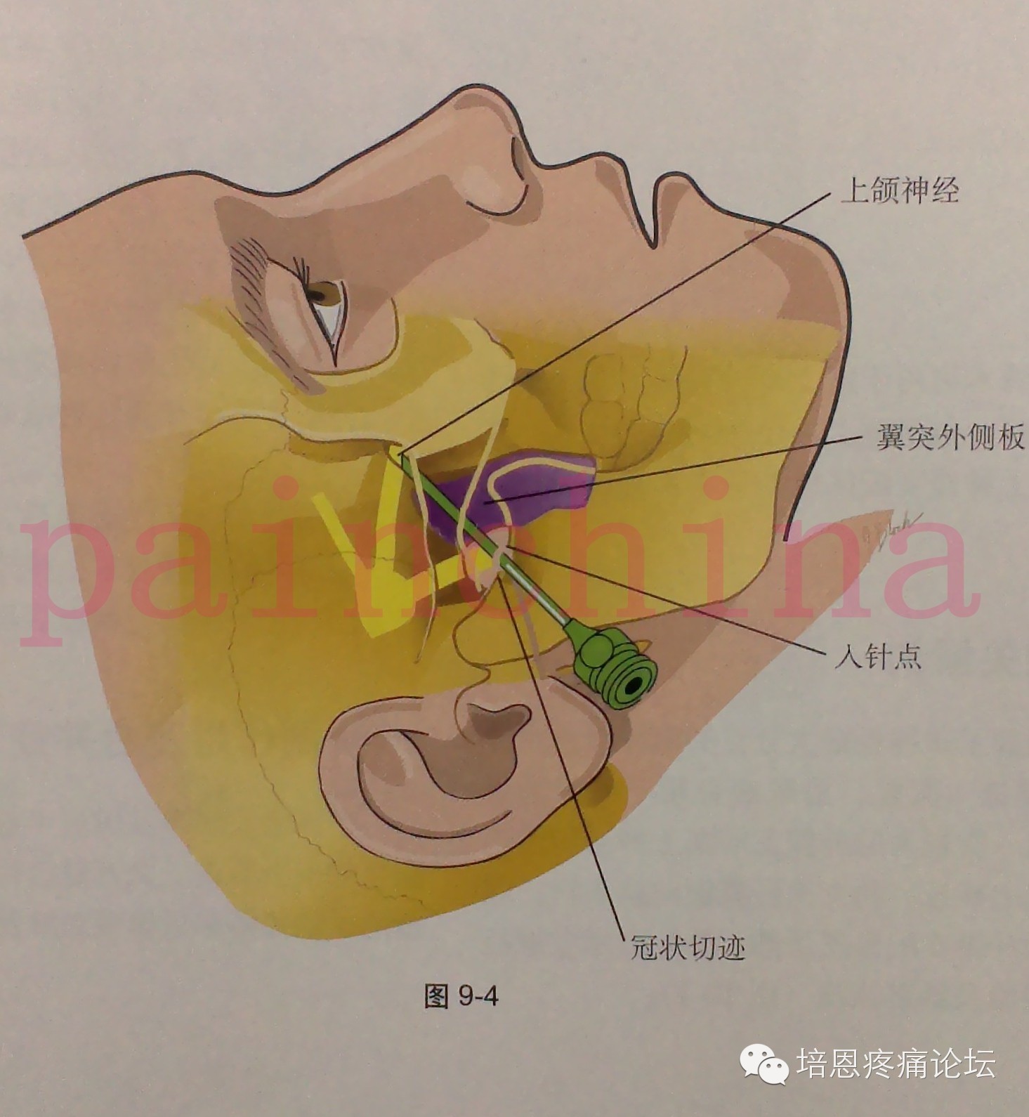 疼痛科常用神经阻滞适应证,解剖点位,操作要点及并发症预防