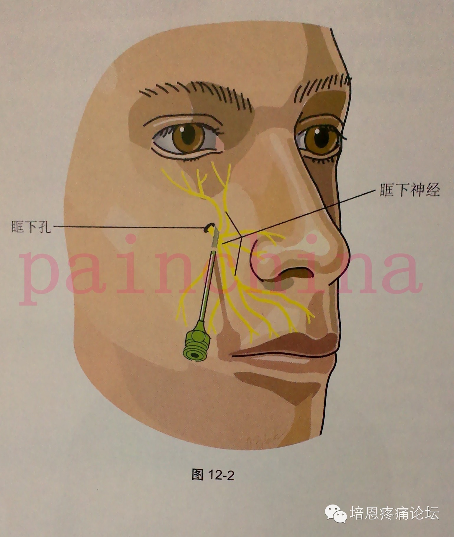 5厘米长,7号针,经眶下孔进针,刺入2-2.5厘米即可注射消炎镇痛液1.5ml.